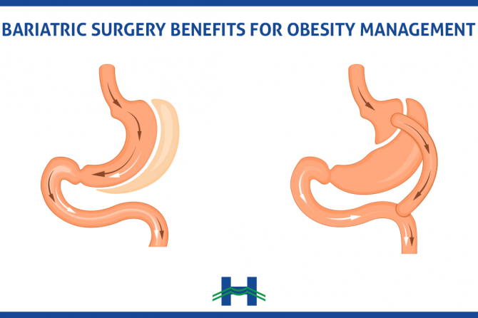Bariatric surgery benefits for obesity management
